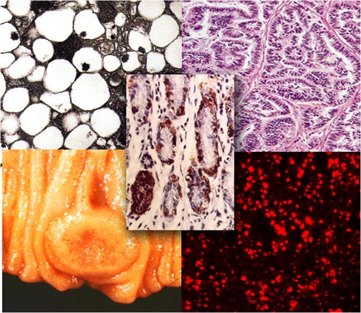 carcinoid cells
